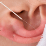 Managing Drug, Alcohol and Cigarette Addiction with Acupuncture