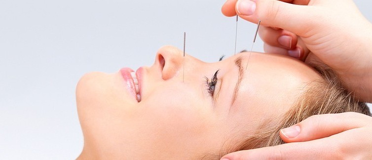 Acupuncture beauty Treatment in Tralee